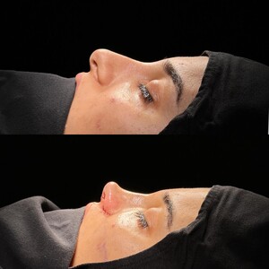 Image of Umman Tunç - Rhinoplasty Clinic Gallery 1