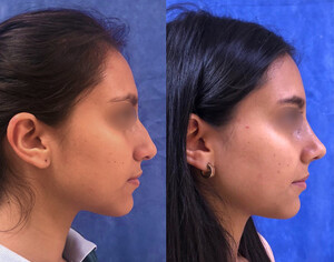 Image of Nose job