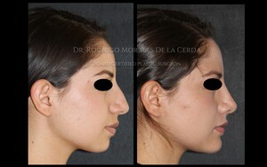 Image of Rhinoplasty