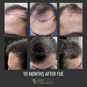 Image of Hair transplant