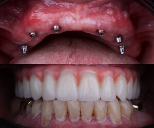 Image of All on 6 dental implants