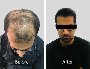 Image of Hair Transplantation Before and After