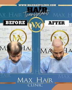 Image of Hair transplant