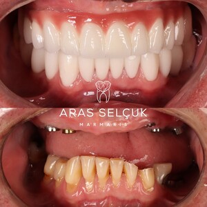 Image of Dental Implants - Marmaris Dental Clinic