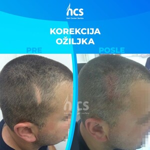 Image of Before and after hair transplant