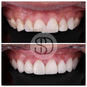 Image of Smile makeover with veneers