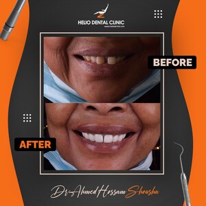 Image of Hollywood smile - Helio Dental Clinic