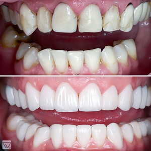 Image of Smile Makeover - Delta Clinic Dent