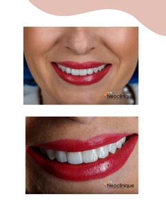 Image of Hollywood smile makeover - Neoclinique