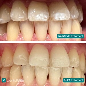 Image of Veneers - Dental Elite