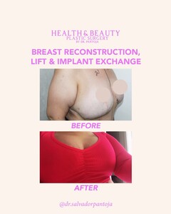 Image of Breast Reconstruction, Lift and Implant Exchange