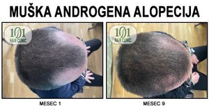 Image of PRP treatment for hair loss