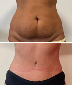 Image of Tummy tuck