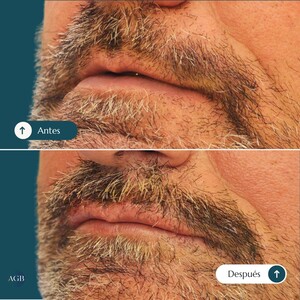 Image of Lip Lift