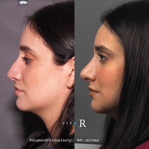 Image of VIP-Rhinoplasty Center - Dr. Moireas Georgios Gallery 1