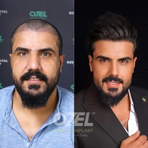 Image of Ozel Hair Transplant Gallery 0