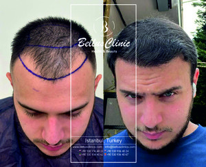 Image of Hair transplant result of our patient from Italy