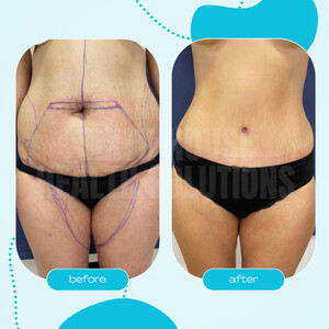 Image of Liposuction - 40th Day Control After Tummy Tuck Surgery - Sixth House Health Solutions