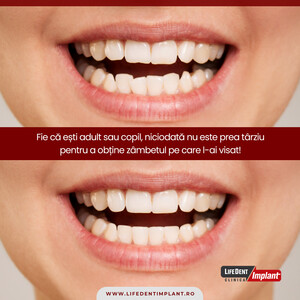 Image of Teeth Whitening - LifeDent Implant