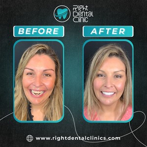 Image of Smile makeover before and after