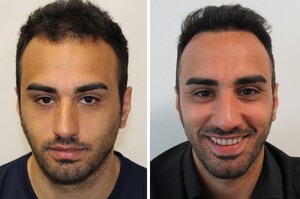 Image of HairPalace hair transplant