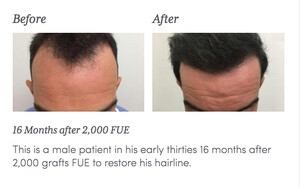 Image of 16 months after FUE hair transplant