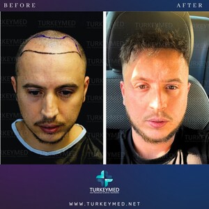 Image of Hair transplant