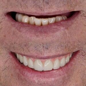 Image of Teeth whitening