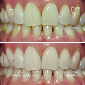 Image of Teeth whitening