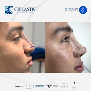 Image of Before and after rhinoplasty