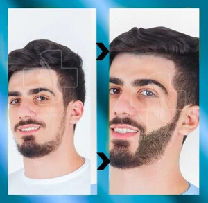 Image of Beard transplantation - Barbatilor Clinic