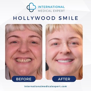 Image of Hollywood Smile makeover