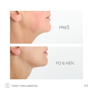 Image of Facelift - SV Plastic Surgery Center