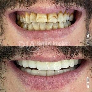 Image of Dental implant Antalia Gallery 0