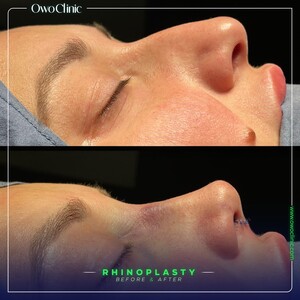 Image of Rhinoplasty