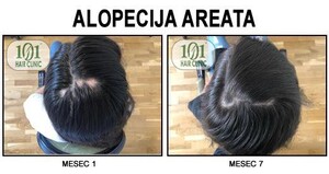 Image of Alopecia treatment