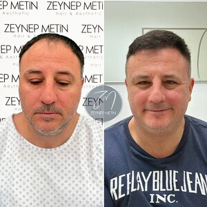 Image of FUE Hair transplant