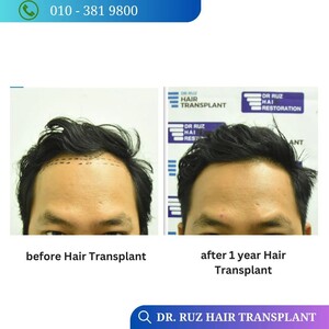 Image of Dr Ruz Hair Transplant Gallery 1