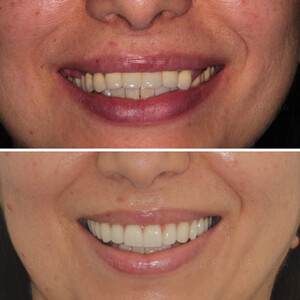 Image of Smile makeover