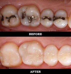 Image of Fillings -  Dr. Wael Fekry