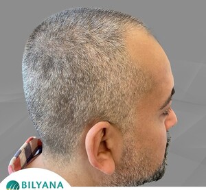 Image of Hair transplant