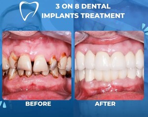 Image of 3 on 8 Dental Implants