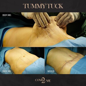 Image of Tummy tuck