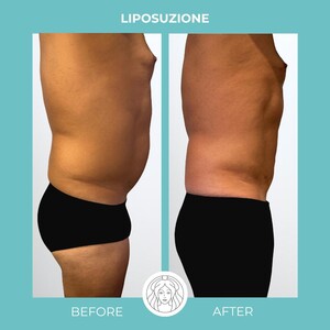 Image of Liposuction - Dr Juri Tassinari