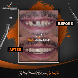 Image of Dental Implant - Helio Dental Clinic