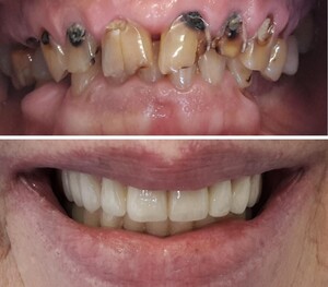 Image of Zirconia crowns