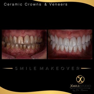 Image of Hollywood Smile Makeover- Xmile Studio Dental Clinic