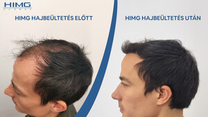 Image of Hair transplant