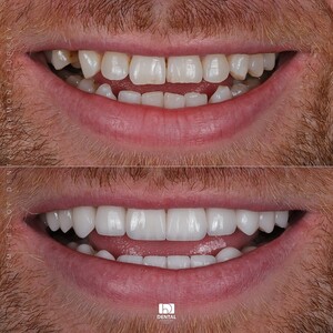 Image of E.max Laminate Veneers