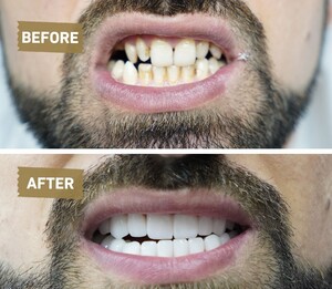 Image of Hollywood smile before and after